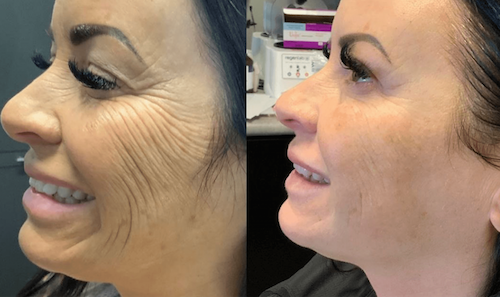 Facial Lifting Skin Tightening Mississauga Oakville